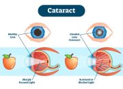 Katarak: Penyebab, Gejala, dan Pengobatan Paling Efektif
